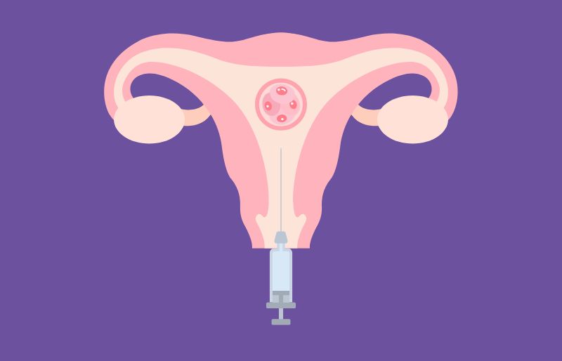 Chuyển phôi IVF là gì