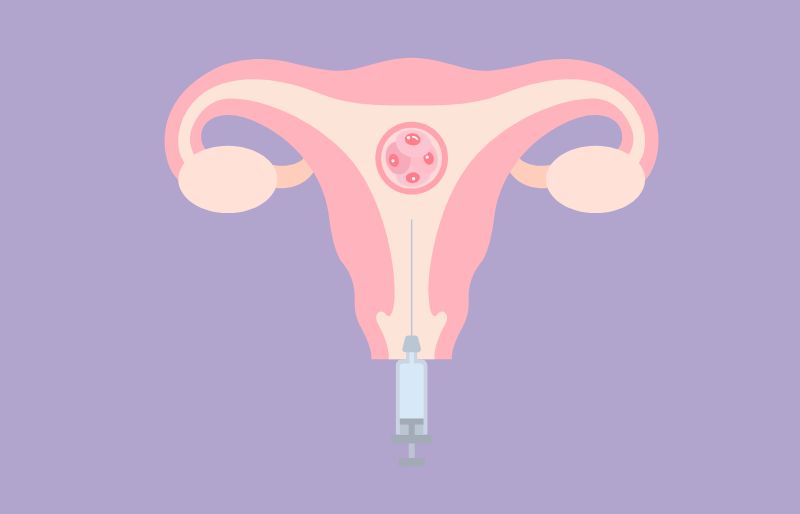 Chuyển phôi trong quy trình làm IVF Chuyển phôi trong quy trình làm IVF