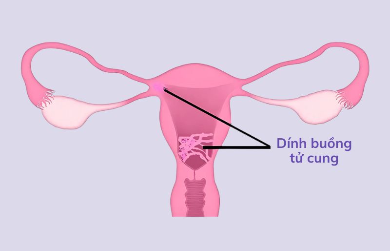Dính buồng tử cung có làm IVF được không