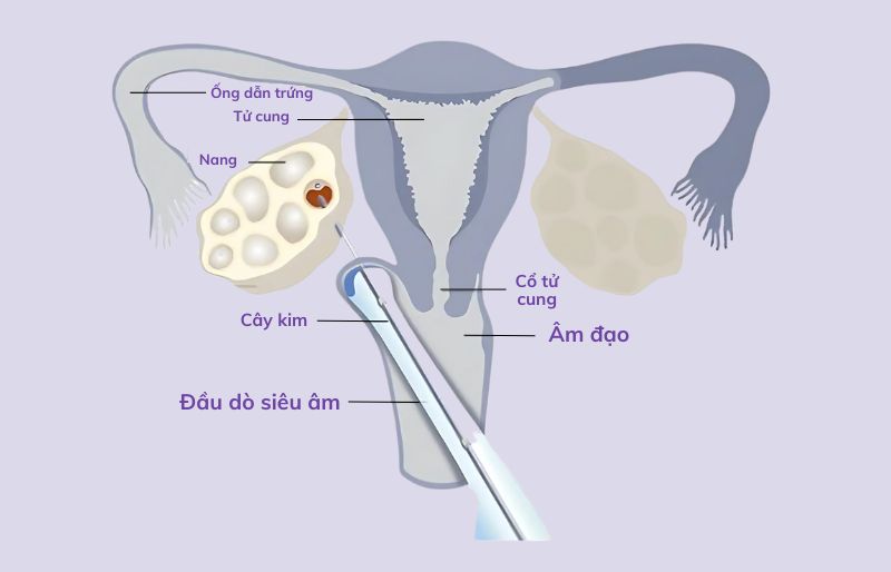 Gom trứng làm IVF