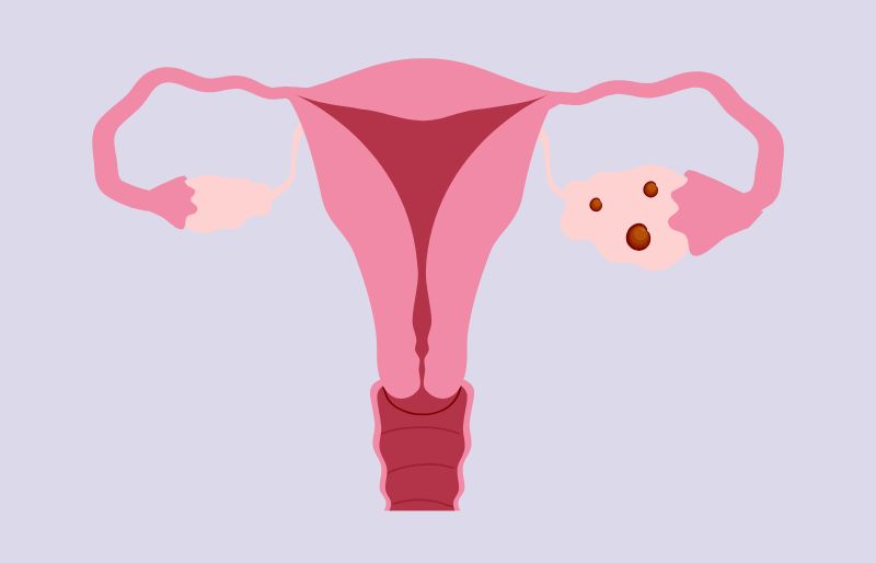 IVF buồng trứng đa nang