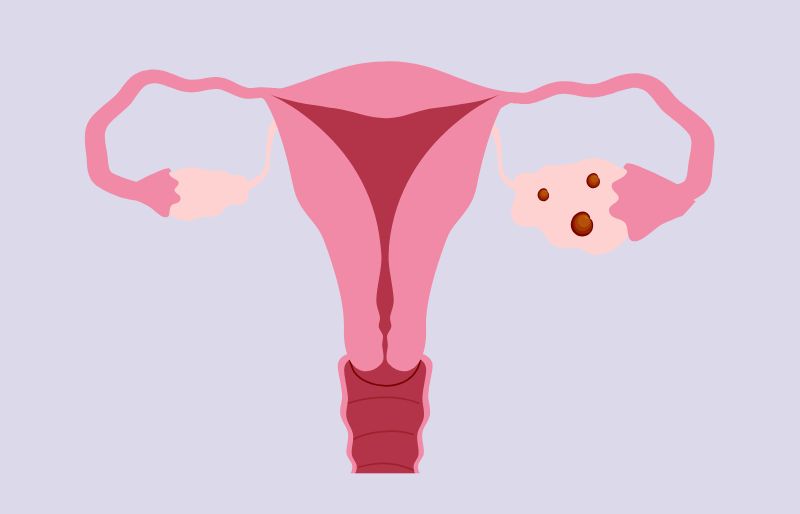 Hội chứng quá kích thích buồng trứng OHSS nặng
